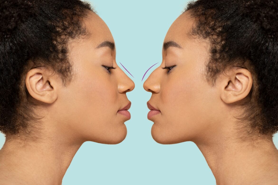 La rhinoplastie : Sculpter son nez pour harmoniser son visage