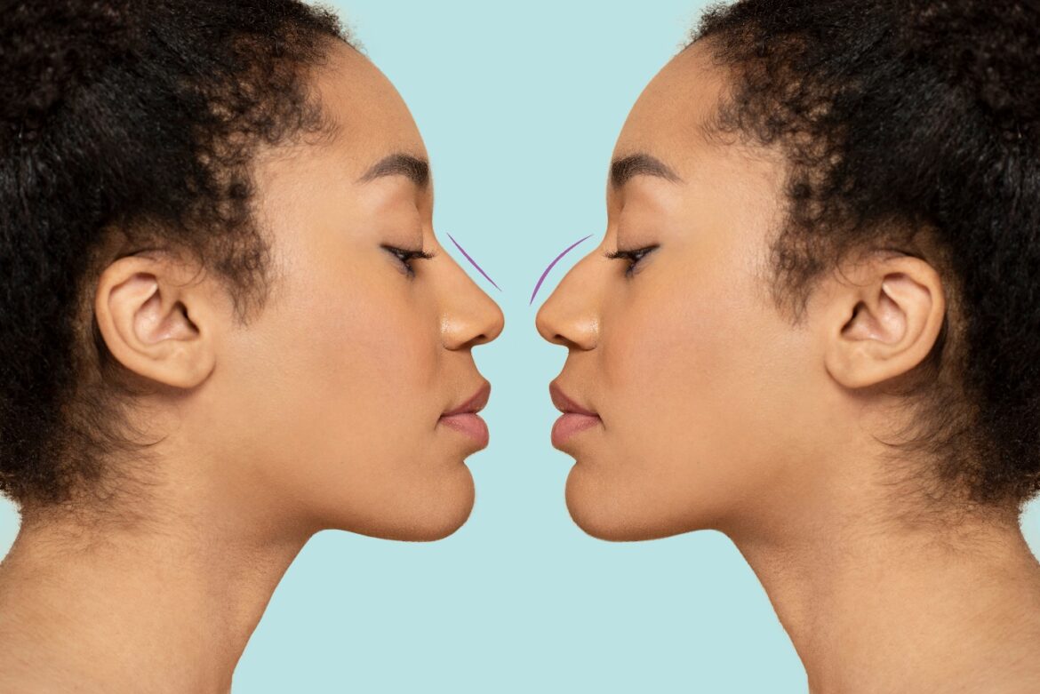 La rhinoplastie : Sculpter son nez pour harmoniser son visage